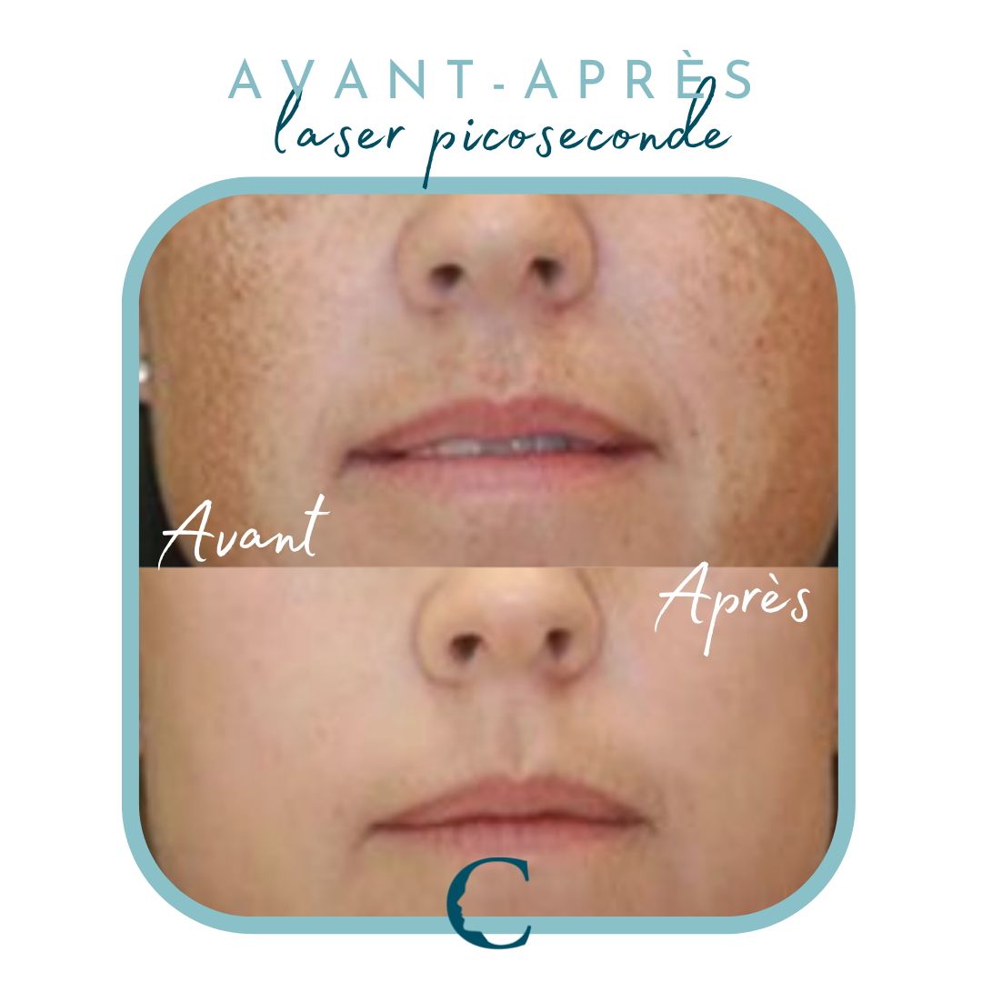 Laser picoseconde Lyon 