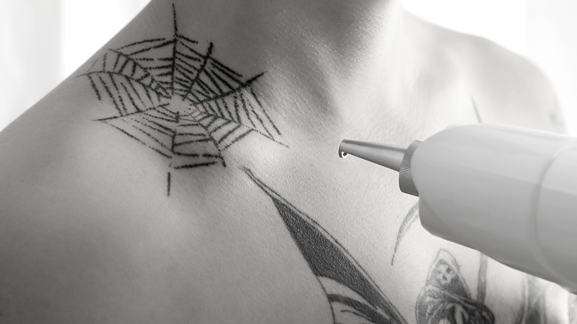 Détatouage médical à Lyon