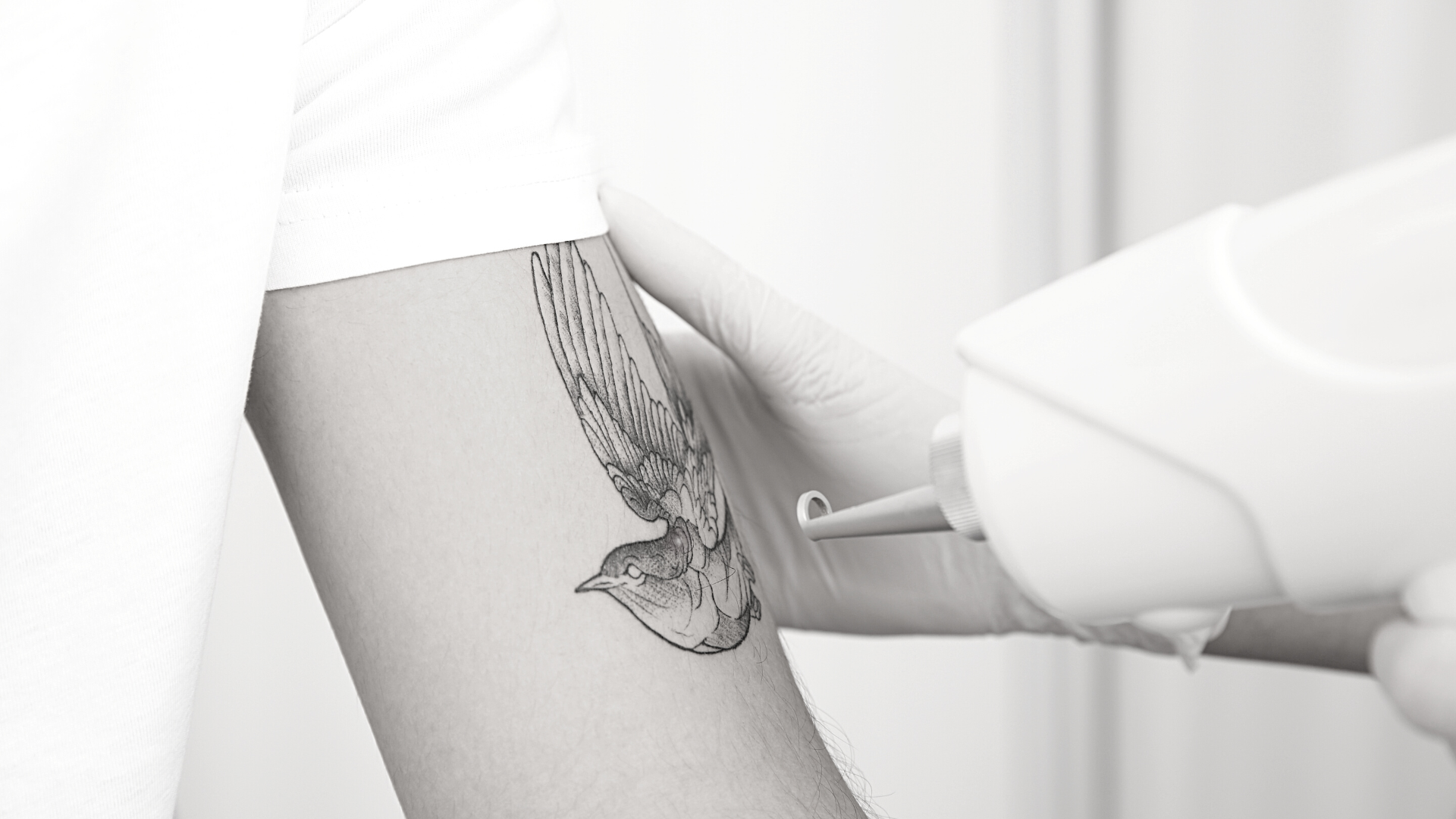 détatouage médical à Lyon 