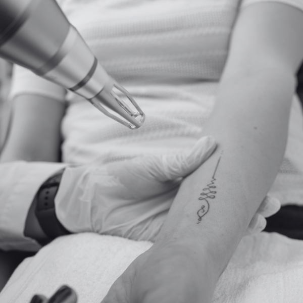 Détatouage laser 